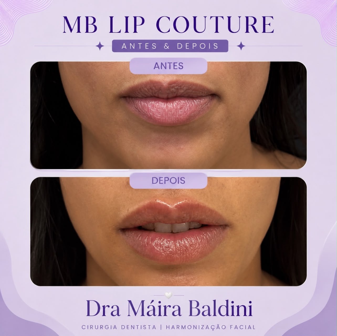 Antes e depois — MB Lip Couture