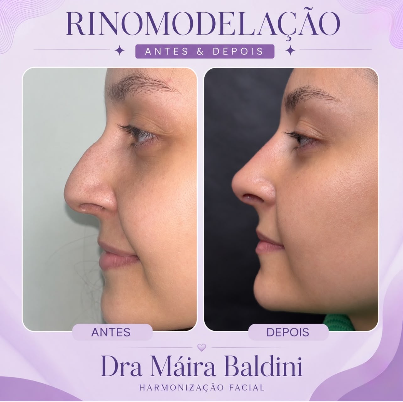 Antes e depois — Rinomodelação