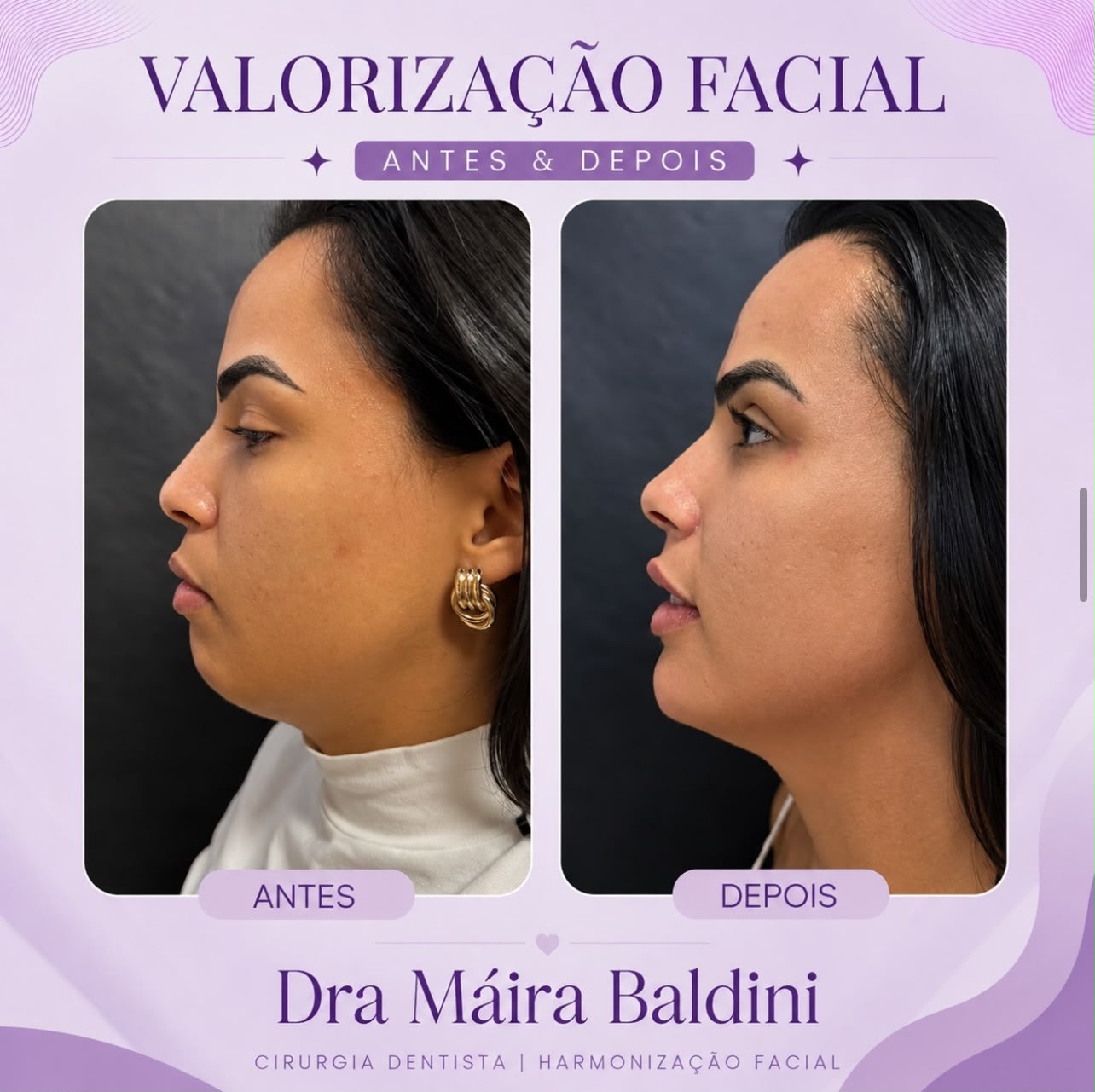 Antes e depois — Valorização Facial